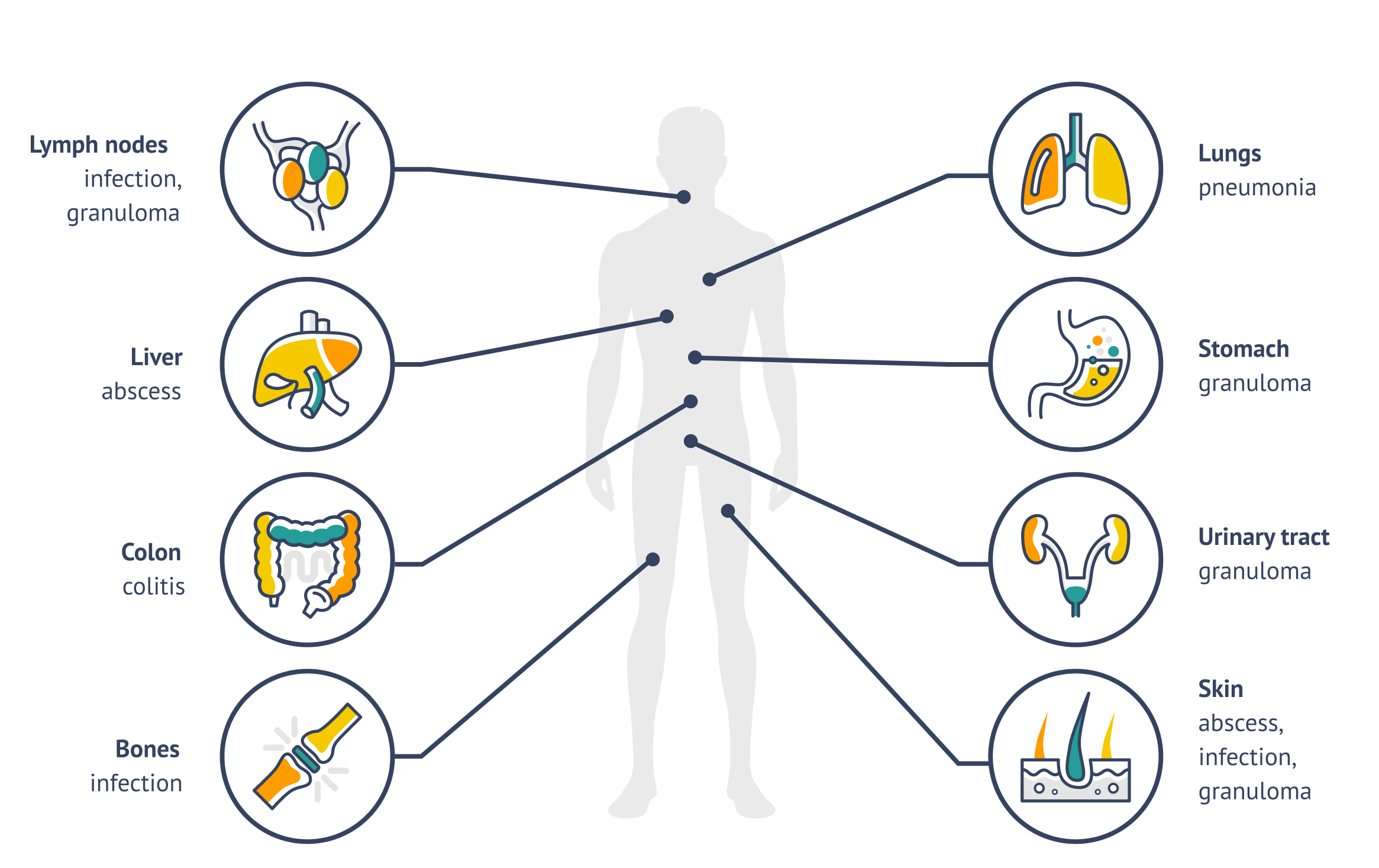 Illustration of where chronic granulomatous disease can affect the body